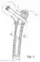 Fig. 02 - Biologic intramedullary fixation device and methods of use