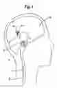 Fig. 02 - Methods and devices for treating obesity, incontinence, and neurological and physiological disorders