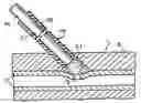 Fig. 01 - Device and method for sealing puncture wounds