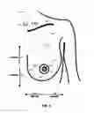 Fig. 04 - MINIMALLY-INVASIVE MASTOPLASTY PROCEDURE USING MULTIPLE BARBED SUTURES AND APPARATUS