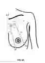 Fig. 05 - MINIMALLY-INVASIVE MASTOPLASTY PROCEDURE USING MULTIPLE BARBED SUTURES AND APPARATUS