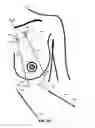 Fig. 07 - MINIMALLY-INVASIVE MASTOPLASTY PROCEDURE USING MULTIPLE BARBED SUTURES AND APPARATUS