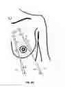 Fig. 08 - MINIMALLY-INVASIVE MASTOPLASTY PROCEDURE USING MULTIPLE BARBED SUTURES AND APPARATUS
