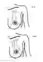 Fig. 09 - MINIMALLY-INVASIVE MASTOPLASTY PROCEDURE USING MULTIPLE BARBED SUTURES AND APPARATUS