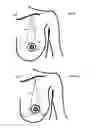 Fig. 10 - MINIMALLY-INVASIVE MASTOPLASTY PROCEDURE USING MULTIPLE BARBED SUTURES AND APPARATUS