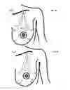 Fig. 11 - MINIMALLY-INVASIVE MASTOPLASTY PROCEDURE USING MULTIPLE BARBED SUTURES AND APPARATUS