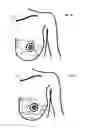 Fig. 12 - MINIMALLY-INVASIVE MASTOPLASTY PROCEDURE USING MULTIPLE BARBED SUTURES AND APPARATUS