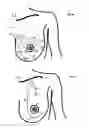 Fig. 13 - MINIMALLY-INVASIVE MASTOPLASTY PROCEDURE USING MULTIPLE BARBED SUTURES AND APPARATUS