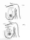 Fig. 14 - MINIMALLY-INVASIVE MASTOPLASTY PROCEDURE USING MULTIPLE BARBED SUTURES AND APPARATUS
