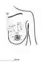 Fig. 15 - MINIMALLY-INVASIVE MASTOPLASTY PROCEDURE USING MULTIPLE BARBED SUTURES AND APPARATUS