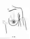 Fig. 16 - MINIMALLY-INVASIVE MASTOPLASTY PROCEDURE USING MULTIPLE BARBED SUTURES AND APPARATUS