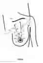 Fig. 17 - MINIMALLY-INVASIVE MASTOPLASTY PROCEDURE USING MULTIPLE BARBED SUTURES AND APPARATUS