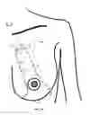 Fig. 19 - MINIMALLY-INVASIVE MASTOPLASTY PROCEDURE USING MULTIPLE BARBED SUTURES AND APPARATUS
