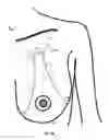 Fig. 20 - MINIMALLY-INVASIVE MASTOPLASTY PROCEDURE USING MULTIPLE BARBED SUTURES AND APPARATUS