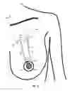 Fig. 21 - MINIMALLY-INVASIVE MASTOPLASTY PROCEDURE USING MULTIPLE BARBED SUTURES AND APPARATUS