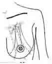 Fig. 22 - MINIMALLY-INVASIVE MASTOPLASTY PROCEDURE USING MULTIPLE BARBED SUTURES AND APPARATUS