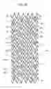 Fig. 30 - Stent and stent delivery device