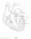 Fig. 02 - Annuloplasty with enhanced anchoring to the annulus based on tissue healing