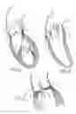 Fig. 02 - Aortic valve prosthesis having natural tissue and an internal cover