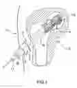 Fig. 02 - Percutaneous hip system