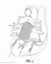 Fig. 02 - METHOD AND APPARATUS FOR PASSIVE LEFT ATRIAL SUPPORT