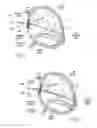 Fig. 34 - Devices, systems, and methods for reshaping a heart valve annulus, including the use of a bridge implant having an adjustable bridge stop