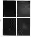 Fig. 05 - Atherosclerosis
