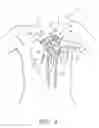 Fig. 02 - Method for Making an Interior Ventricular Patch