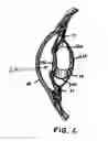 Fig. 03 - Method of preparing a multielement intraocular lens for insertion