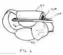 Fig. 09 - Method of preparing a multielement intraocular lens for insertion