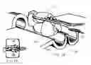 Fig. 11 - Method of preparing a multielement intraocular lens for insertion