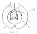 Fig. 12 - Method of preparing a multielement intraocular lens for insertion