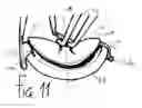 Fig. 14 - Method of preparing a multielement intraocular lens for insertion