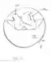 Fig. 22 - Method of preparing a multielement intraocular lens for insertion