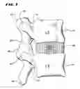Fig. 02 - Facet Arthroplasty Devices and Methods