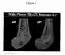 Fig. 02 - PTHRP-BASED PREDICTION AND DIAGNOSIS OF BONE DISEASE
