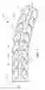 Fig. 02 - Implantable malleable penile prosthetic device
