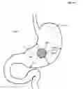 Fig. 41 - Autofluorescent imaging and target ablation