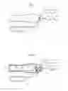 Fig. 02 - Liposculpting device
