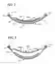 Fig. 03 - ABSORBENT ARTICLES WITH ABSORBENT PAD GAPPING