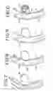 Fig. 04 - Delivery system using balloon catheter with side opening and method