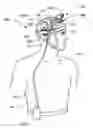 Fig. 01 - Infusion catheter with composite tip