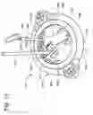 Fig. 26 - Infusion catheter with composite tip
