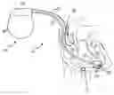 Fig. 01 - Electronic and biological pacemaker systems
