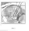 Fig. 02 - Multiple lead method for deep brain stimulation