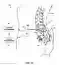 Fig. 02 - Implantable medical lead with threaded fixation
