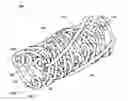 Fig. 01 - Temporal Intraluminal Stent, Methods of Making and Using