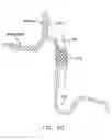 Fig. 71 - Method and apparatus for reducing mitral regurgitation