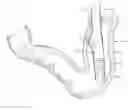 Fig. 01 - Use of biosurgical adhesive on inflatable device for gastric restriction