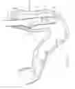 Fig. 02 - Use of biosurgical adhesive on inflatable device for gastric restriction